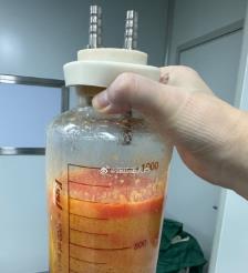 宣城水动力吸脂手术要做多久？
